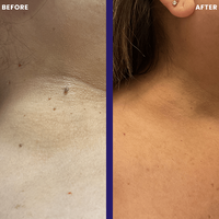 TagPal - Skin Tag Removal Profesional Kit para eliminar verrugas cutáneas + Crema para la piel Grátis