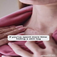 TagPal - Skin Tag Removal Profesional Kit para eliminar verrugas cutáneas + Crema para la piel Grátis