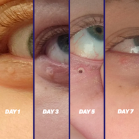 TagPal - Skin Tag Removal Profesional Kit para eliminar verrugas cutáneas + Crema para la piel Grátis